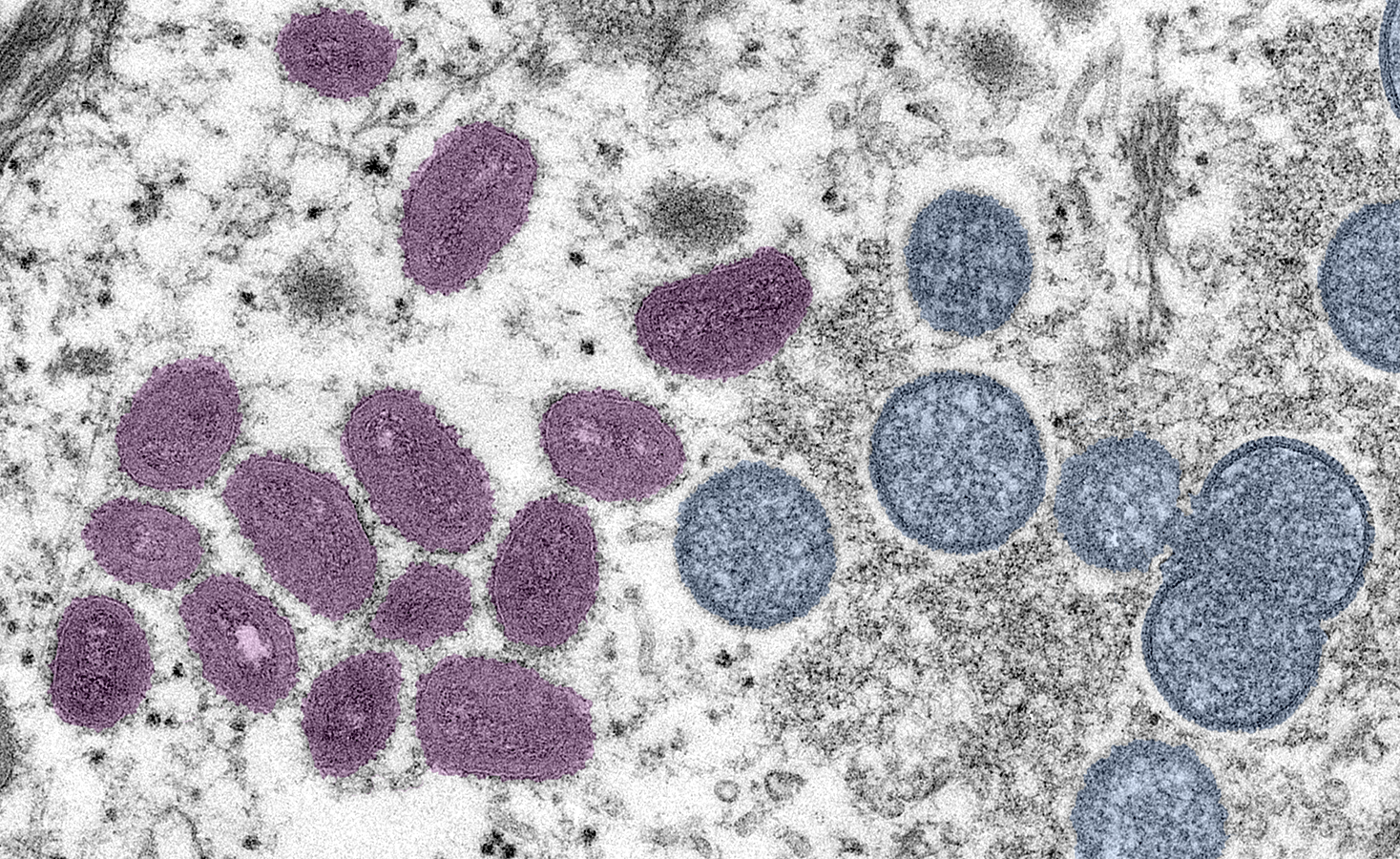 What You Should Know About Monkeypox