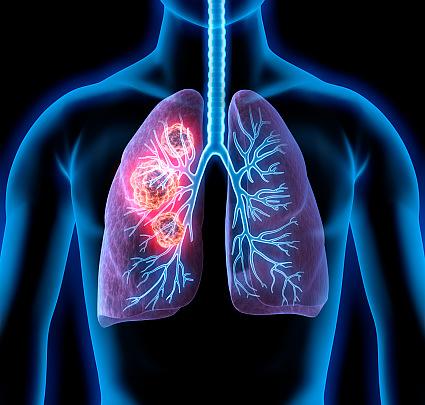 Buffalo Business First: Providers look to new guidelines to find, treat lung cancer earlier