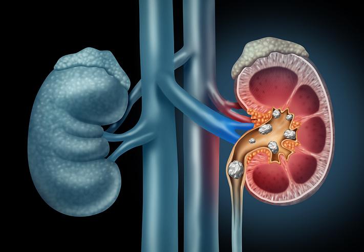 Minimally Invasive Kidney Stone Treatment Available at Kaleida Health; Urology Team Completes 150th Procedure