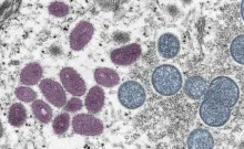 What You Should Know About Monkeypox