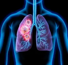 Buffalo Business First: Providers look to new guidelines to find, treat lung cancer earlier